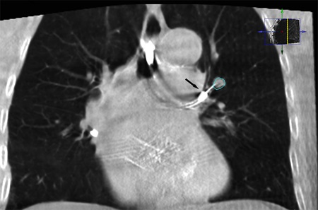 CB-CT, robotic-assisted bronchoscopy, needle biopsy